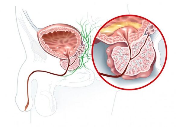 Symptomer vun Prostatitis