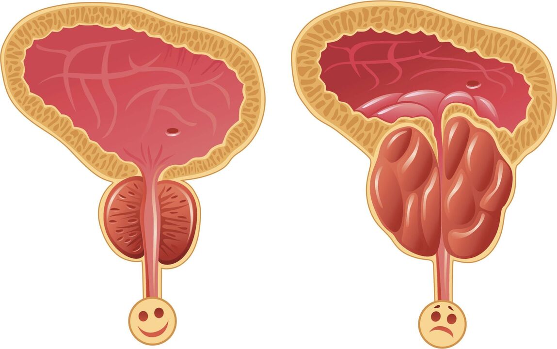 Grënn fir d'Entwécklung vu Prostatitis