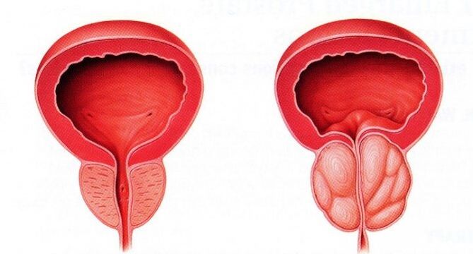 gesond an entzündegt Prostated mat chronescher Prostatitis
