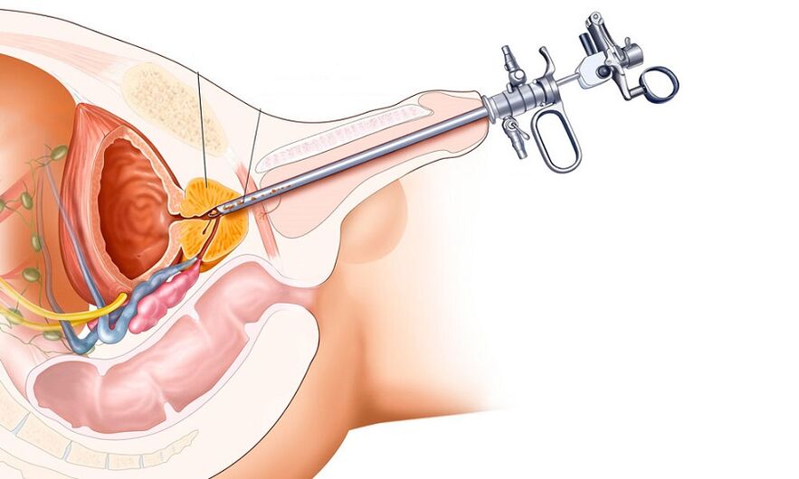 Chirurgesch Behandlung vu Prostatitis