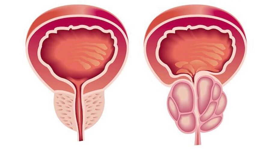 Gesond an entzündegt Prostates mat Prostatitis