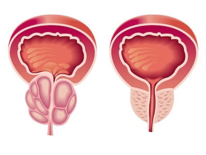 Wéi eng Prostatitis ausgesäit